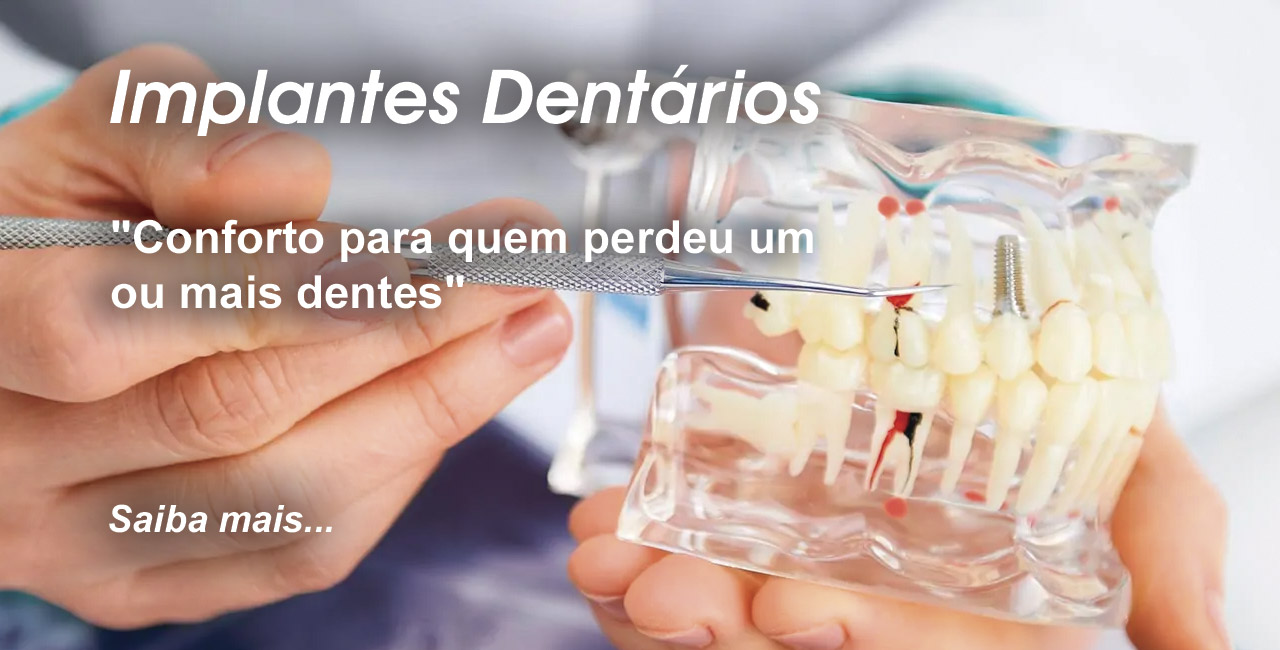 Banner Implantes Dentários Odontologia Koza