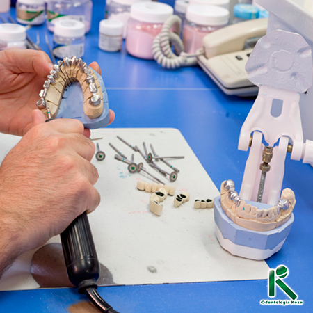 Impressão 3D de Prótese - Odontologia Koza