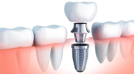 Foto Tratamento Implantes Dentários - Odontologia Koza