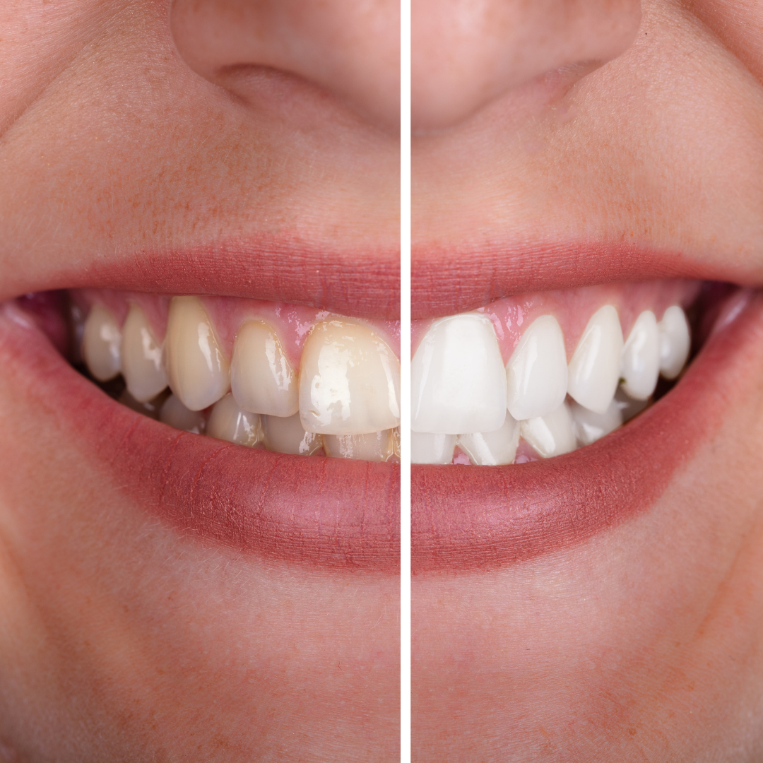 Clareamento Dental na Odontologia Koza