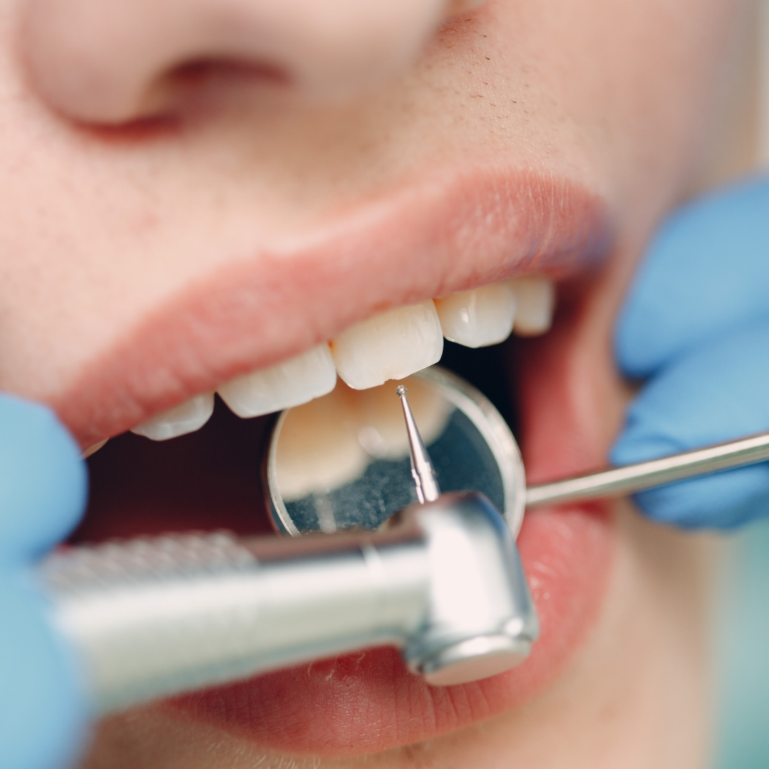 Limpeza e Profilaxia na Odontologia Koza