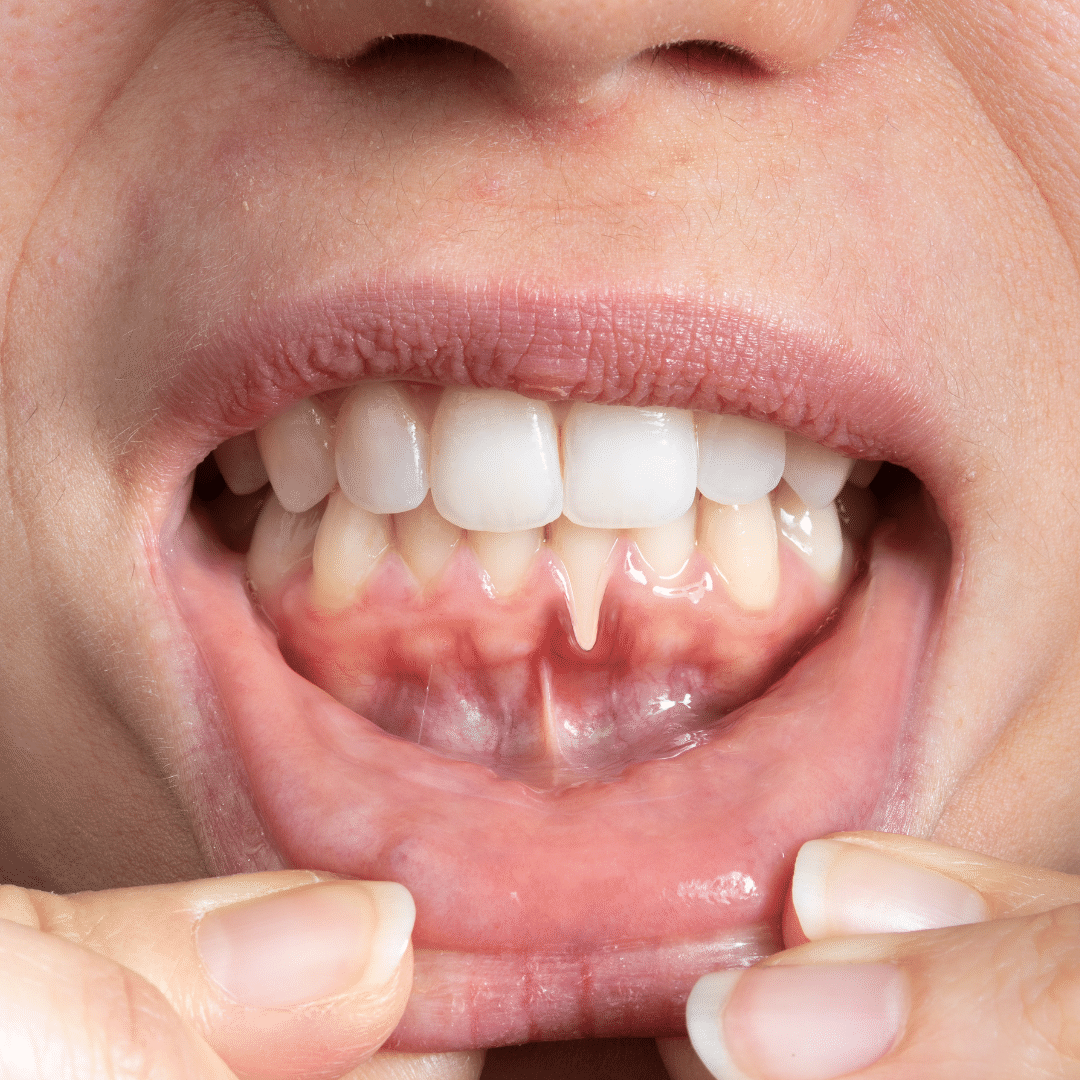 img-periodontite-sintomas-tratamento-odontologia-koza